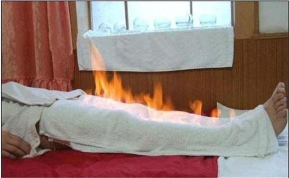 中醫(yī)火療的原理？